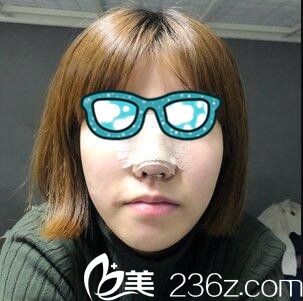 韓國清潭整形外科李丙玟鼻綜合真人案例術(shù)后第三天 韓國清潭整形外科李丙玟鼻綜合真人案例術(shù)后第三天
