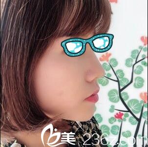 韓國清潭整形外科李丙玟鼻綜合真人案例術(shù)后第七天 韓國清潭整形外科李丙玟鼻綜合真人案例術(shù)后第七天