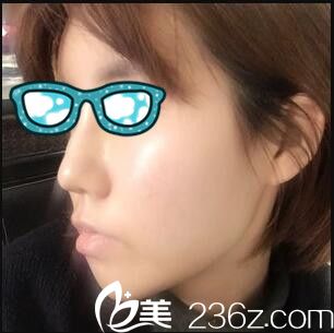 韓國清潭整形外科李丙玟鼻綜合真人案例術(shù)后第九天 韓國清潭整形外科李丙玟鼻綜合真人案例術(shù)后第九天