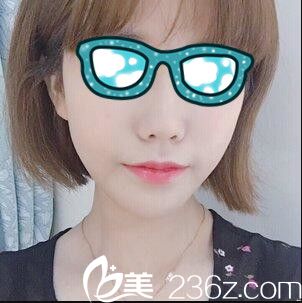 韓國清潭整形外科李丙玟鼻綜合真人案例術(shù)后十八天 韓國清潭整形外科李丙玟鼻綜合真人案例術(shù)后十八天