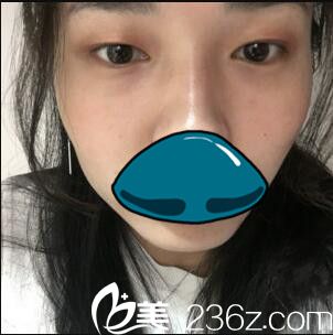 韓國清潭整形外科成鎮(zhèn)模雙眼皮真人案例 韓國清潭整形外科成鎮(zhèn)模雙眼皮真人案例