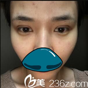 韓國清潭整形外科成鎮(zhèn)模雙眼皮真人案例術后天 韓國清潭整形外科成鎮(zhèn)模雙眼皮真人案例術后天