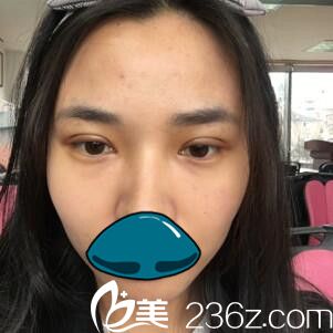 韓國清潭整形外科成鎮(zhèn)模雙眼皮真人案例術后第三天 韓國清潭整形外科成鎮(zhèn)模雙眼皮真人案例術后第三天