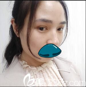 韓國清潭整形外科成鎮(zhèn)模雙眼皮真人案例術后第五天 韓國清潭整形外科成鎮(zhèn)模雙眼皮真人案例術后第五天