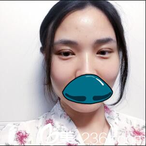 韓國清潭整形外科成鎮(zhèn)模雙眼皮真人案例術后第七天 韓國清潭整形外科成鎮(zhèn)模雙眼皮真人案例術后第七天