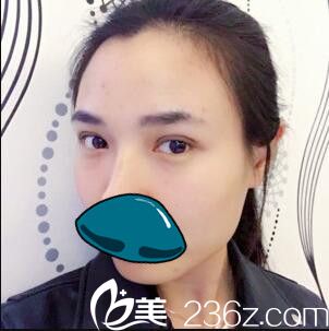 清潭成鎮(zhèn)模做的雙眼皮十一天就恢復好了，果然名不虛傳