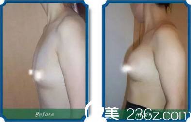 胸部整形前后效果對比 胸部整形前后效果對比