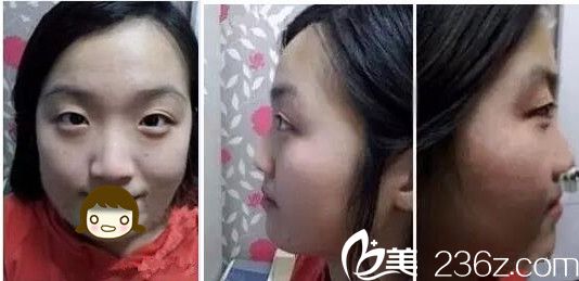 焦作麗人眼鼻整形術(shù)前 焦作麗人眼鼻整形術(shù)前