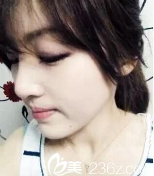 焦作麗人隆鼻手術(shù)后1個月 焦作麗人隆鼻手術(shù)后1個月