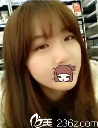 焦作麗人眼鼻整形術(shù)后2個月 焦作麗人眼鼻整形術(shù)后2個月