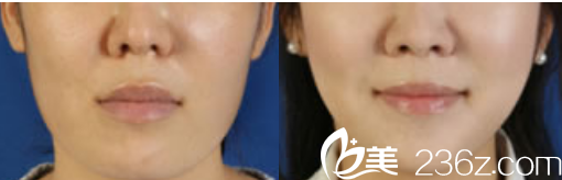 韓國Members整形外科醫(yī)院案例 韓國Members整形外科醫(yī)院案例