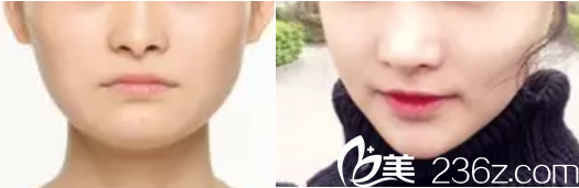 韓國(guó)Members整形外科醫(yī)院案例 韓國(guó)Members整形外科醫(yī)院案例