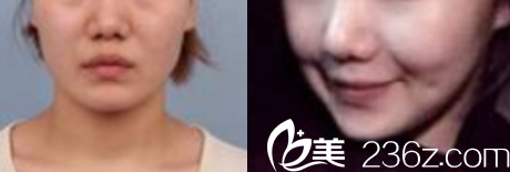 韓國(guó)Members整形外科醫(yī)院案例 韓國(guó)Members整形外科醫(yī)院案例