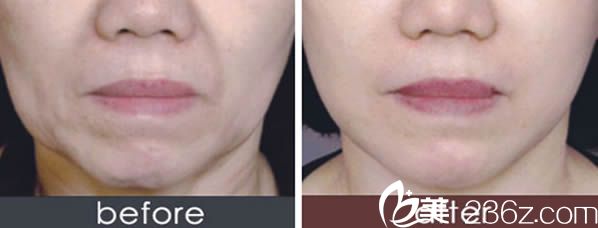 方躍明醫(yī)生注射除皺案例 方躍明醫(yī)生注射除皺案例