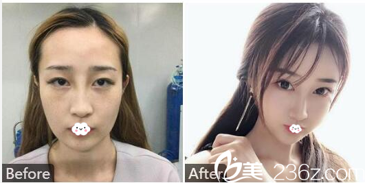 深圳南西子整形醫(yī)院鄭舉衛(wèi)自體脂肪面部填充案例