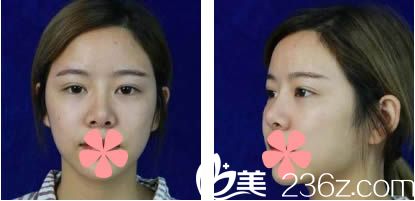 在<!--<i data=20240703-sp></i>-->整形醫(yī)院做隆鼻術(shù)前照 在<!--<i data=20240703-sp></i>-->整形醫(yī)院做隆鼻術(shù)前照