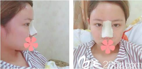 做完綜合隆鼻術(shù)后第1天 做完綜合隆鼻術(shù)后第1天