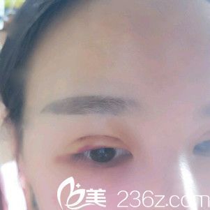 術(shù)后即刻效果 術(shù)后即刻效果