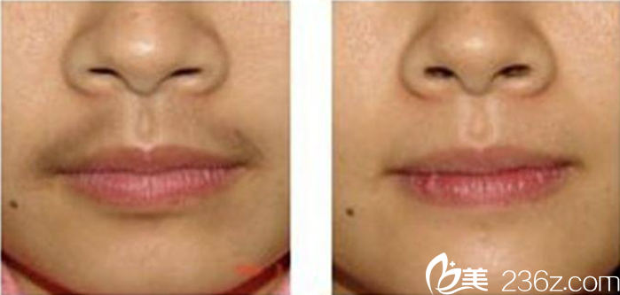 竇芳芳醫(yī)師脫毛案例 竇芳芳醫(yī)師脫毛案例