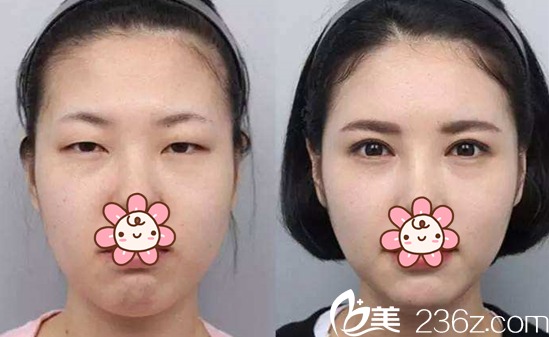 杜萬文醫(yī)師腫眼泡案例