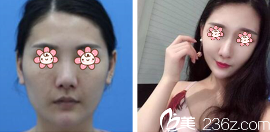 王金紅醫(yī)師面部線雕案例