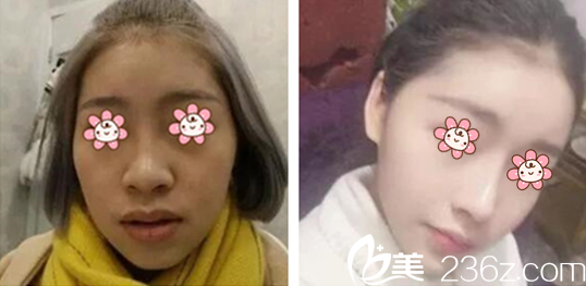 董彭濤醫(yī)師隆鼻案例