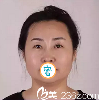 <!--<i data=20240703-sp></i>-->悅美治療術前照 <!--<i data=20240703-sp></i>-->悅美治療術前照