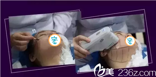 <!--<i data=20240703-sp></i>-->悅美治療過程 <!--<i data=20240703-sp></i>-->悅美治療過程