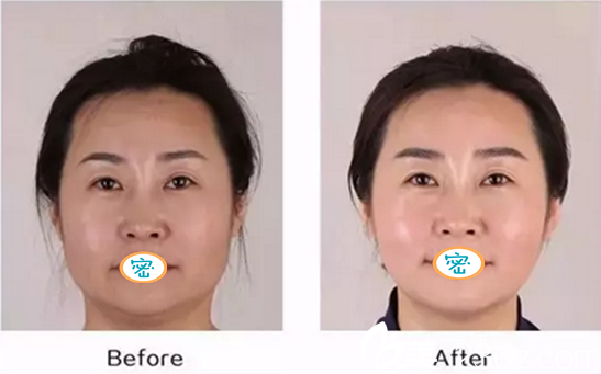 治療術后半個月對比照片 治療術后半個月對比照片