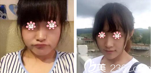 柳榮<!--<i data=20240703-sp></i>-->長(zhǎng)瘦臉V神針案例 柳榮<!--<i data=20240703-sp></i>-->長(zhǎng)瘦臉V神針案例