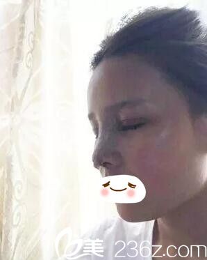 雙眼皮+鼻綜合術(shù)后即刻