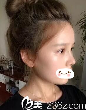 術(shù)后一周眼鼻恢復(fù)中