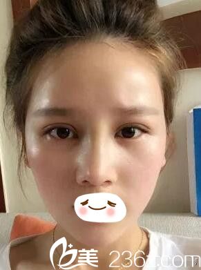 汪涌醫(yī)生眼鼻修復(fù)術(shù)后半個月