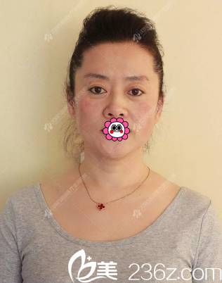 做皮膚管理前的照片 做皮膚管理前的照片