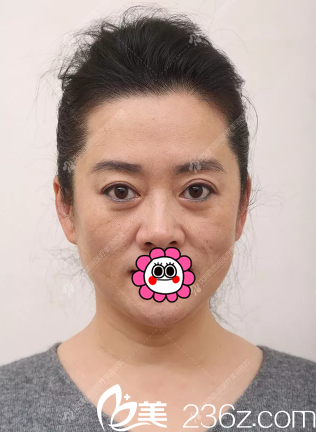 做完皮膚除皺后的效果 做完皮膚除皺后的效果