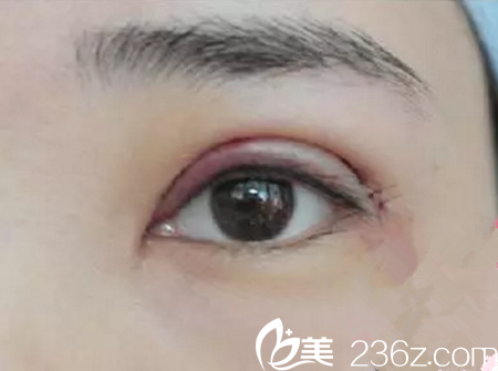 術(shù)后第二天 術(shù)后第二天