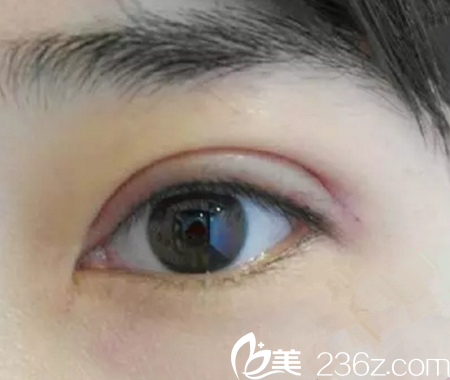 第七天拆線后 第七天拆線后