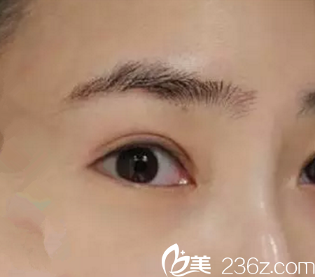 哈爾濱藝星微創(chuàng)雙眼皮術(shù)后恢復(fù)到底有多快？劉德成醫(yī)生真人案例