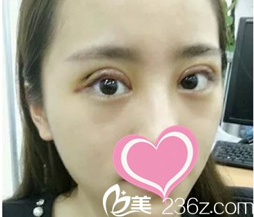 全切雙眼皮第二天 全切雙眼皮第二天