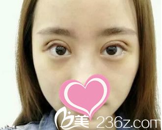 割雙眼皮第三天 割雙眼皮第三天