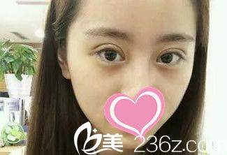 雙眼皮第七天拆線后 雙眼皮第七天拆線后