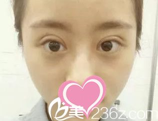 全切雙眼皮第九天 全切雙眼皮第九天