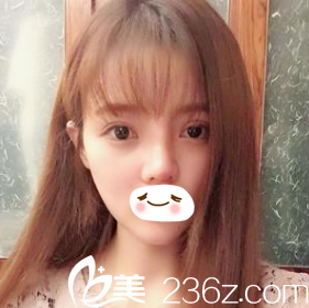 術(shù)后第十天效果 術(shù)后第十天效果