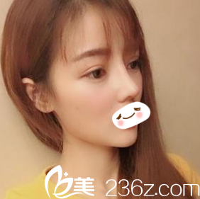 韓國時雨整形醫(yī)院鼻整形真人案例：從平凡少女到小仙女的距離就差一個鼻綜合