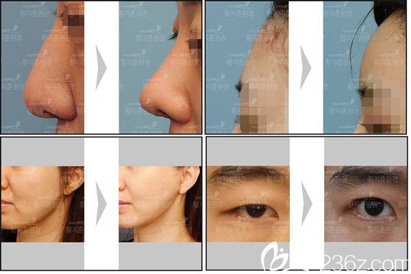 韓國(guó)延世Saint整形外科案例