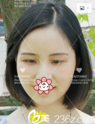 想不到我這種頑固的淚溝型眼袋重慶曹陽麗格美容醫(yī)院也給弄好了！