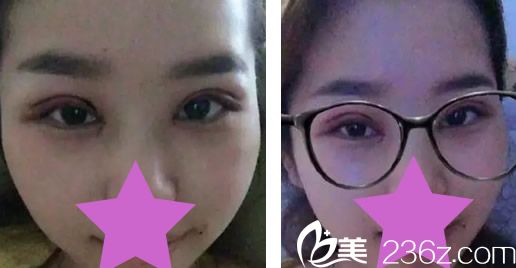 割了雙眼皮加開眼角第1天 割了雙眼皮加開眼角第1天