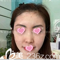 臉部脂肪填充后35天的樣子 臉部脂肪填充后35天的樣子
