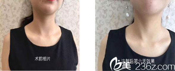 祛頸紋案例1