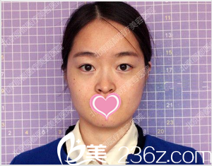 在北京米蘭柏羽麗都做雙眼皮隆鼻前樣子 在北京米蘭柏羽麗都做雙眼皮隆鼻前樣子